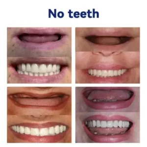 NESLEMY™- Advanced Customized Full Denture Set