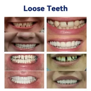 NESLEMY™- Advanced Customized Full Denture Set