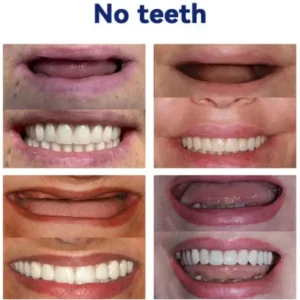 AEXZR™ Advanced Full Denture Set