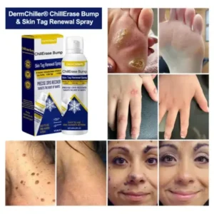 DermChiller® ChillErase Bump & Skin Tag Renewal Spray